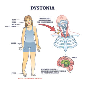 classification-of-dystonia