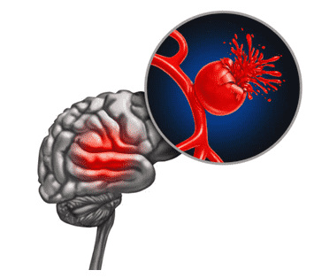 indications-for-craniectomy-after-hemorrhagic-stroke