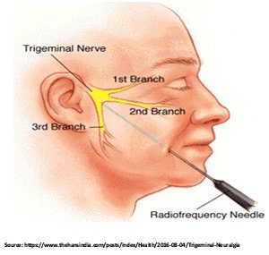 Radiofrequency Thermocoagulation