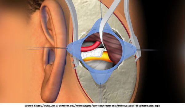 Microvascular decompression