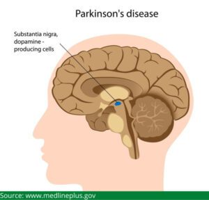 Parkinson’s disease