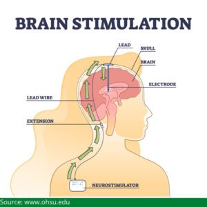 Deep Brain Stimulation