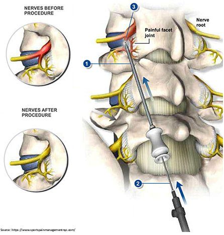 radiculopathy 