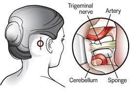 Microvascular Decompression for Trigeminal Neuralgia