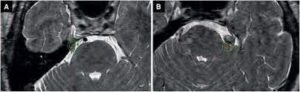 Trigeminal Neuralgia