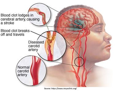 carotid artery disease