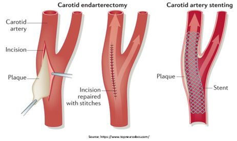 carotid artery disease