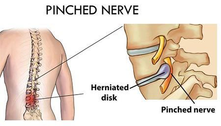 Damage to the nerves