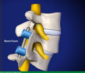 Spinal Fusion