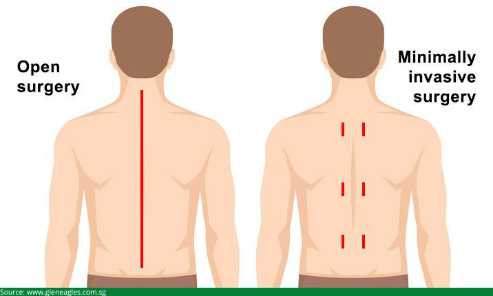 minimally invasive spine surgery