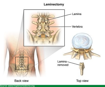 Laminectomy