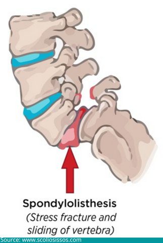 What are the conditions requiring a spinal fusion