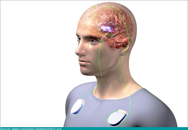 Deep brain stimulation