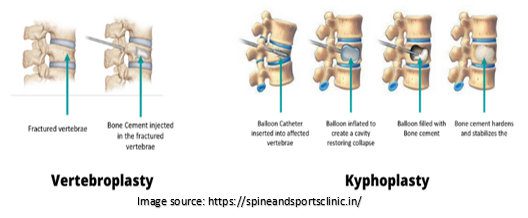 Types of Back Surgery