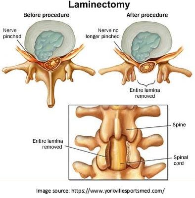 laminectomy