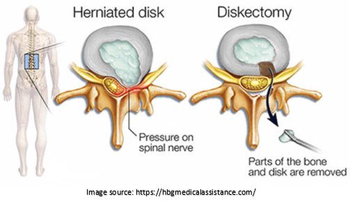 Discectomy