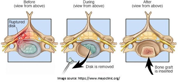 Spinal fusion