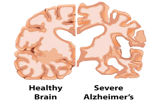 alzheimers-disease