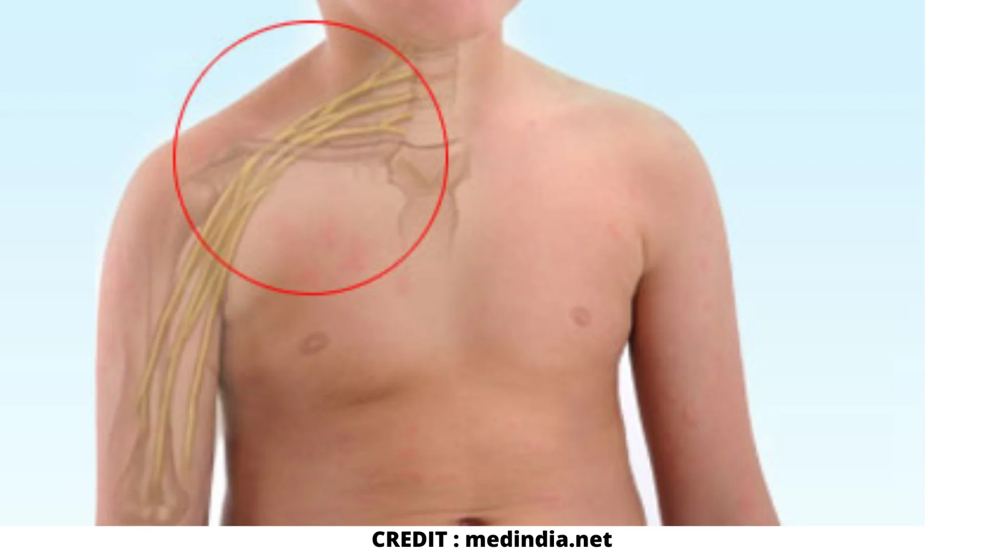 brachial plexus injury