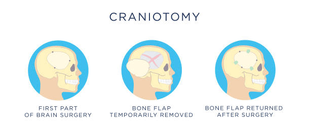 carinotomy