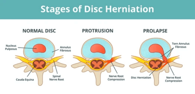 Is it Normal to Have a Recurrent Slipped Disc