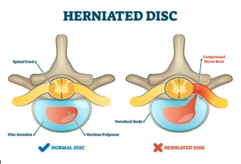 Why Does My Herniated Disc Keep Coming Back