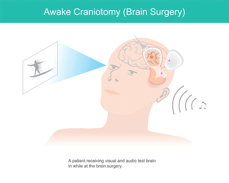 Awake Brain Surgery