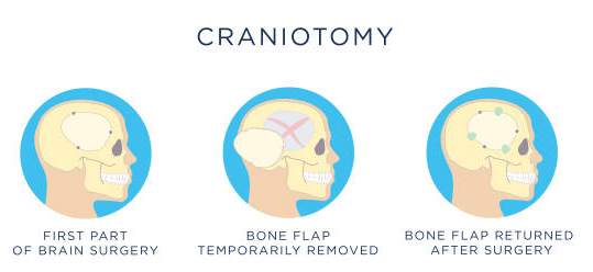 Craniotomy