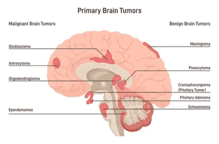 Primary Brain Tumor