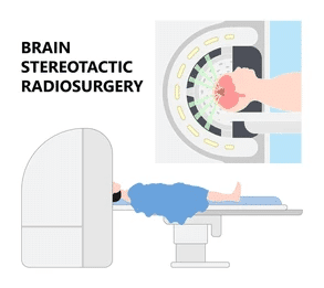 Stereotactic Surgery