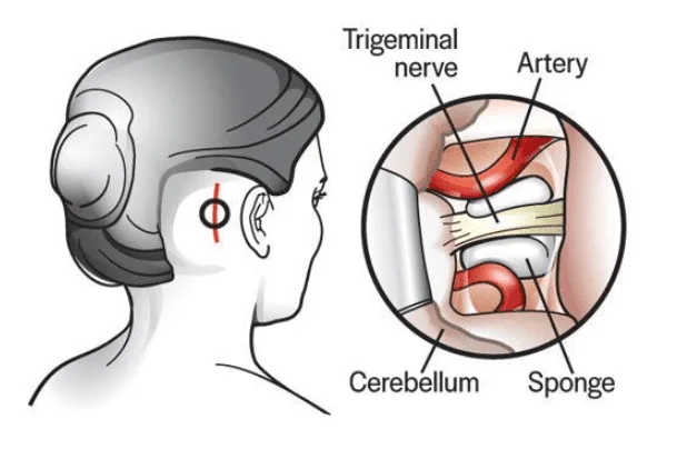 5 | Gurneet Managing Trigeminal Neuralgia Neck and Shoulder Pain