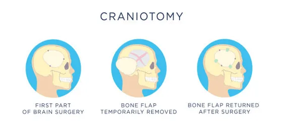 Craniotomy