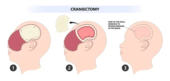 Decompressive Craniectomy
