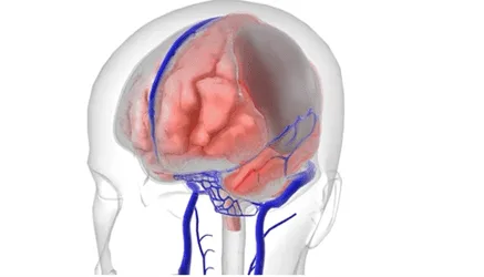 Subdural Hematoma