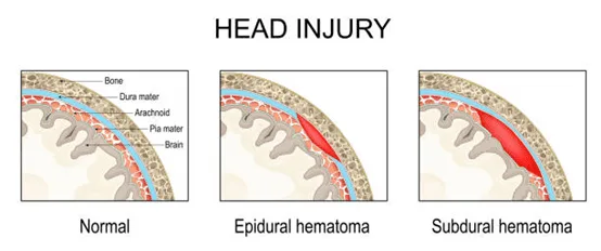 Head injury