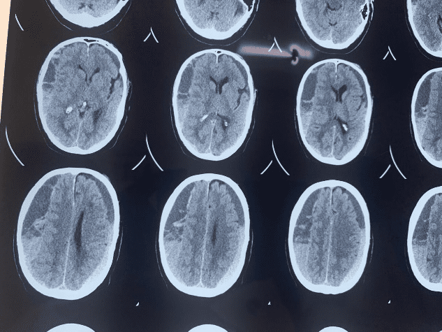 Treatment Options for Subdural Hematoma 2 Months Later