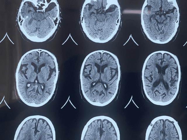 Treatment Options for Subdural Hematoma 2 Months Later