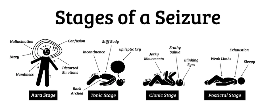 Infographic showing four seizure stages: Aura (dizziness, confusion); Tonic (stiff body); Clonic (jerky movements); Postictal (exhaustion, sleepiness).