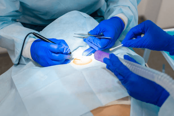 Surgeons in blue gloves perform a procedure, using forceps and instruments over a sterile drape-covered patient.