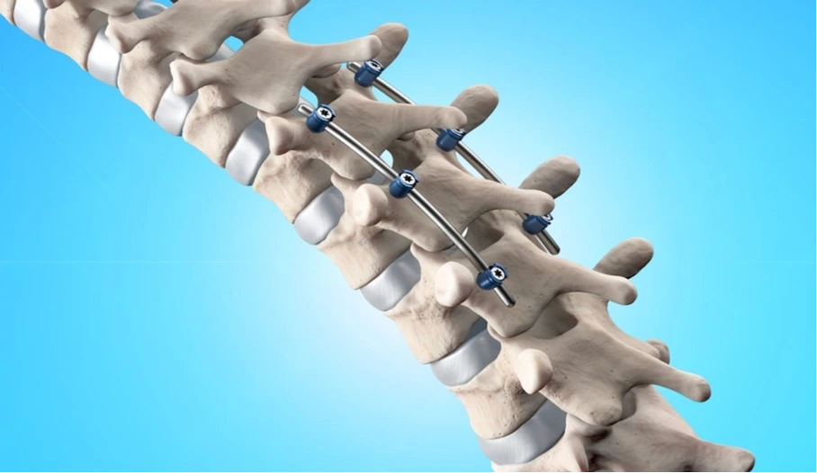 sym Picture 3 | Gurneet Spine model with metal pedicle screws and rods illustrating spinal fusion hardware