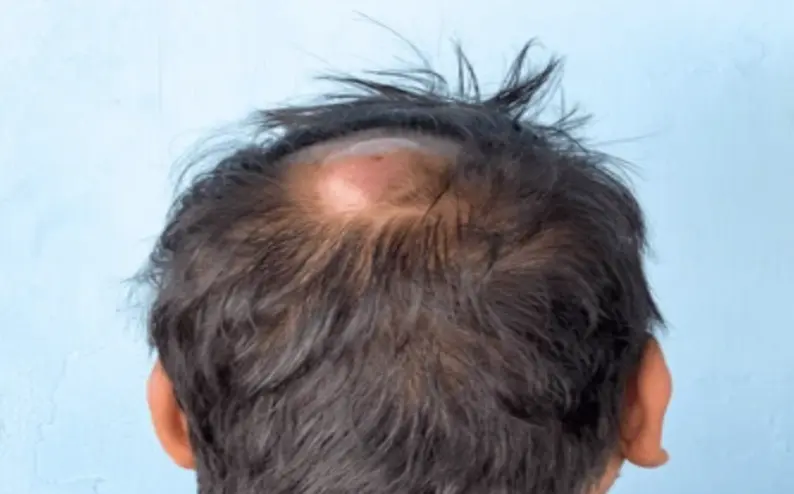 Back of a person's head showing a bald spot on the crown with surrounding dark hair against a light blue wall.
