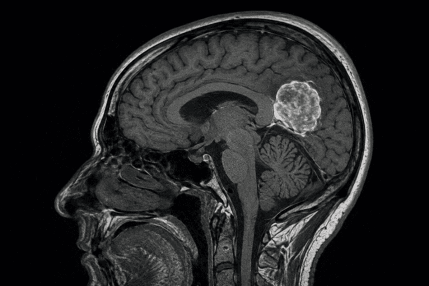 New image gurneet | Gurneet Sagittal MRI of the head showing a large round cerebellar tumor pressing on the brainstem in the posterior fossa.