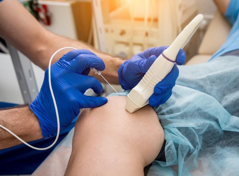 Radiofrequency Ablation for Severe Bilateral Hand Tremors