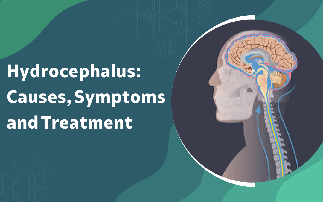 Hydrocephalus: What Causes, Symptoms and Treatment?