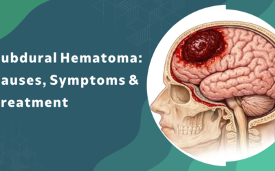 What are the causes, symptoms, and treatment options for subdural hematoma?