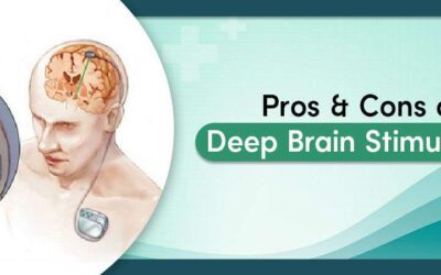 Pros and Cons of Deep Brain Stimulation