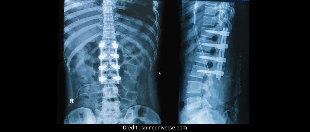 Does spinal fusion limit mobility