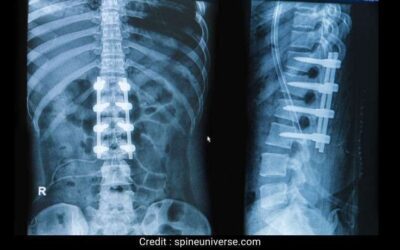 Does spinal fusion limit mobility