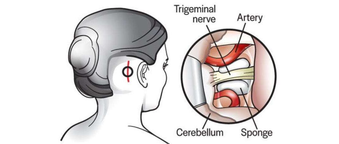 Neurovascular Surgery for Trigeminal Neuralgia