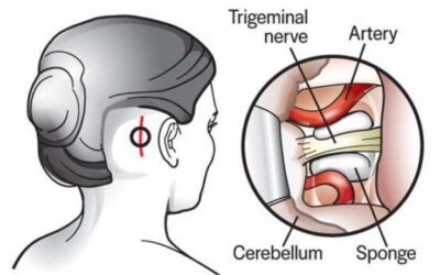 Neurovascular Surgery for Trigeminal Neuralgia